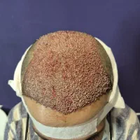 نیاز به نیرو تکنسین کاشت مو دارم