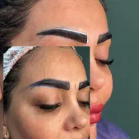 مشاوره بلفاروپلاستی و کاشت ابرو توسط پزشک