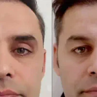 افتادگی پلک