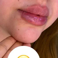 ژل چانه گونه بوکال فقط ۹۵۰ تضمینی