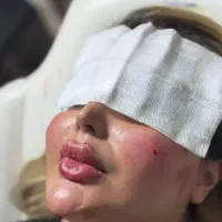 فیلر لب فقط1/200،بوتاکس باترمیم رایگان،حجم باسن