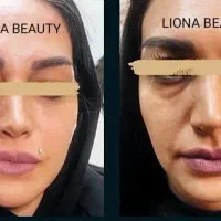 آموزش ژل،بوتاکس،نخ،مزوترا پی با مدرک بین المللی