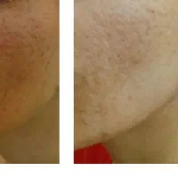از بین بردن لک و کک  ومک صورت