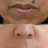 خال برداری تحت نظر پزشک