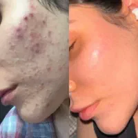پاکسازی پوست/فیشال/رفع تیرگی بدن/مزونیدلینگ/اسکالپ
