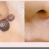 ریمووابرو خال و زگیل ولک قهوه ای