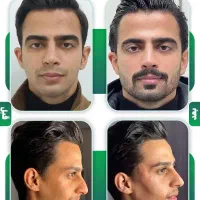 خداحافظی با خطوط اخم و لبخند با فیلر و بوتاکس و ژل