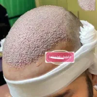 جشنواره کاشت مو، ابرو