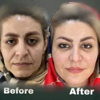 ۳۰٪جشنواره کمبوتکنیک چهره کارت تخفیف تزریق پزشک
