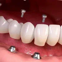 مرکز تخصصی ایمپلنت فیکسچر کره ای زیبایی دندان