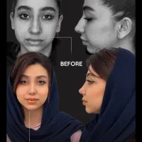 عمل بینی/تمدید تخفیف اخرماه/با پیزو/بدون تامپون/۳۵|خدمات آرایشگری و زیبایی|تهران, دزاشیب|دیوار
