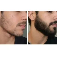رویش ریش و سیبیل در ۳ هفته