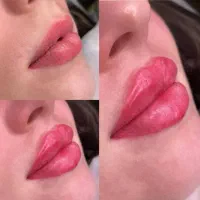تزریق فیلر و بوتاکس در صدرا