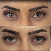 بلفاروپلاستی فقط۵تومان وساکشن غبغب۷تومن