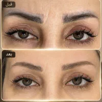 * پاک کردن تاتوهای قدیمی ابرو با لیزر