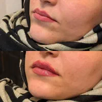 مشاوره نخ لیفت و جوانسازلاغری تزریق  ژل و بوتاکس