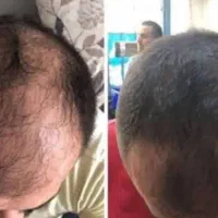 تو میتونی درمان کنی موهات رو