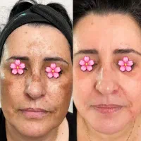 شماهم اگه لک پوستی داری مشاوره رایگان بگیرید