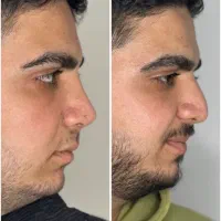 عمل زیبای بینی