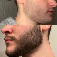 رویش و پرپشتی ریش