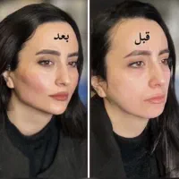 مدل فوری فیلر و بوتاکس در مطب تخصصی