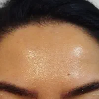 بوتاکس طبیعی درهرسنی