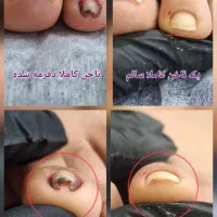 درمان ناخن های اسیب دیده پا