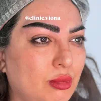 میکرو کاشت ابرو، کاشت مژه تضمینی