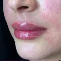 ژل ، مزوژل جوانساز ، بوتاکس ، پی ارپی ، خالبرداری