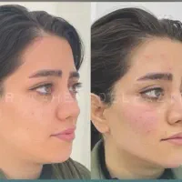 برداشتن خال،حذف تاتو با لیزر و تمام تزریقات زیبایی