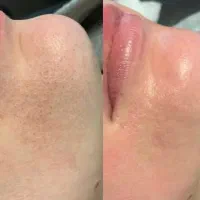 فیشیال تخصصی پوست و سم زدایی کل بدن