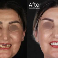 ایمپلنت‌فول‌فک‌بالا‌وپایین/تخفیف ‌تا آخراردیبهشت‌
