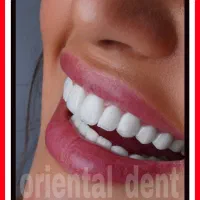 عصبکشی/ترمیم/روکش بریج دندان بلیچینگ کامپوزیت