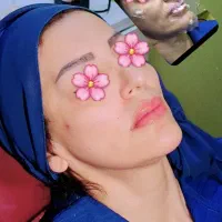 تخفیف ۲۰ درصدی خدمات ژل و بوتاکس