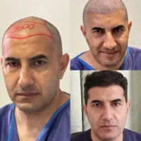 کاشت مو و ابرو شیرازی