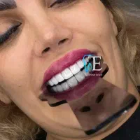 عیدانه/پرکردن/ترمیم/ کامپوزیت