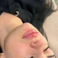 بوتاکس و فیلر (جشنواره تابستانی)