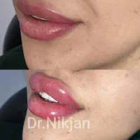 فیلر/ژل/بوتاکس/جوانساز/لیزر