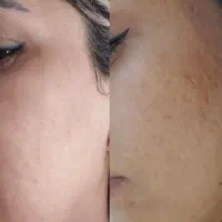 اموزش مبتدی و تخصصی پاکسازی و فیشال پوست