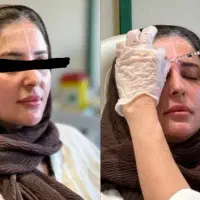 جشنواره بوتاکس مصپورت توسط پزشک فقط 900  تومان