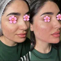 اموزش ژل وبوتاکس لیزر