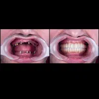 ایمپلنت تمام دیجیتال ۹/۸۰۰بااقساط دوساله بدون سود