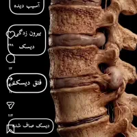 سیاتیک پا دیسک کمر آرتروز گردن و زانو
