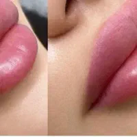 جشنواره تخفیف ژل و فیلر بوتاکس پی آرپی مزو