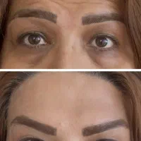مدل ژل و بوتاکس *تخفیف ویژه *