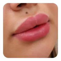 تزریق ژل لب رایگان تعداد محدود