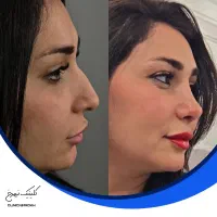 عمل بینی با تخفیف ویژه