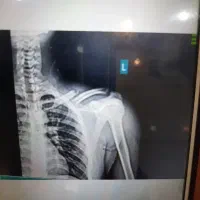 شکسته بندی و در رفتگی