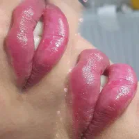 لیزر موی زائد تزریق ژل و بوتاکس نخ امبدینگ کاشان
