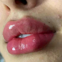 تزریق ژل وبوتاکس کره ای